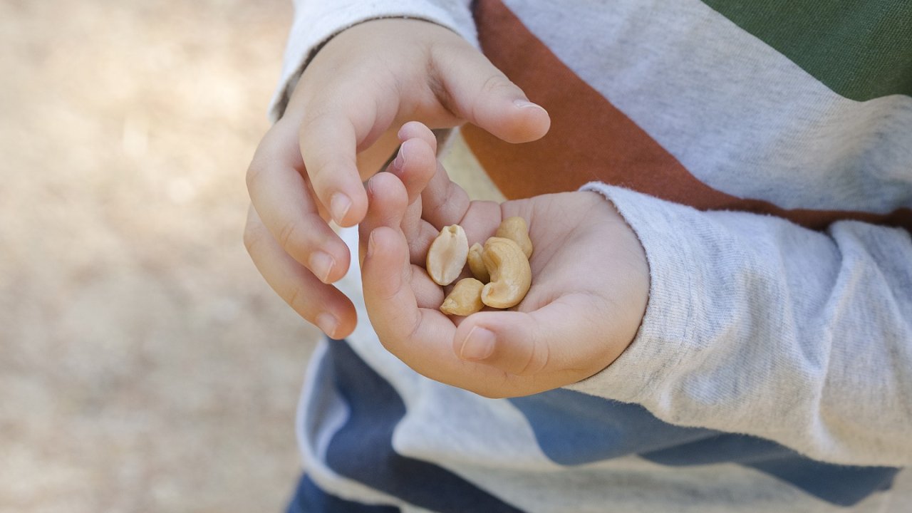 Nut Allergies, Symptoms and Treatments